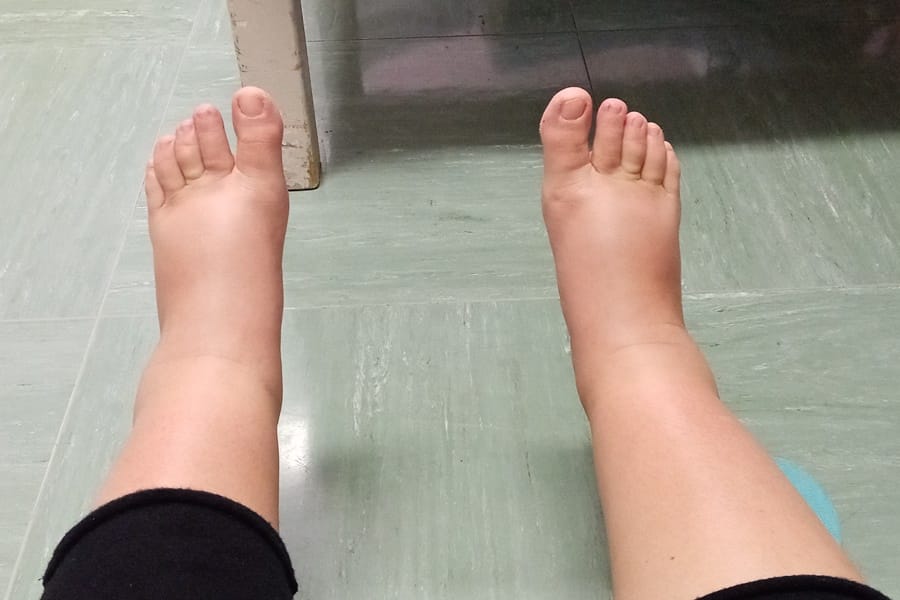 piedi gonfi gravidanza